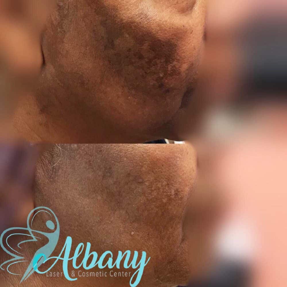 Melasma treatment Edmonton