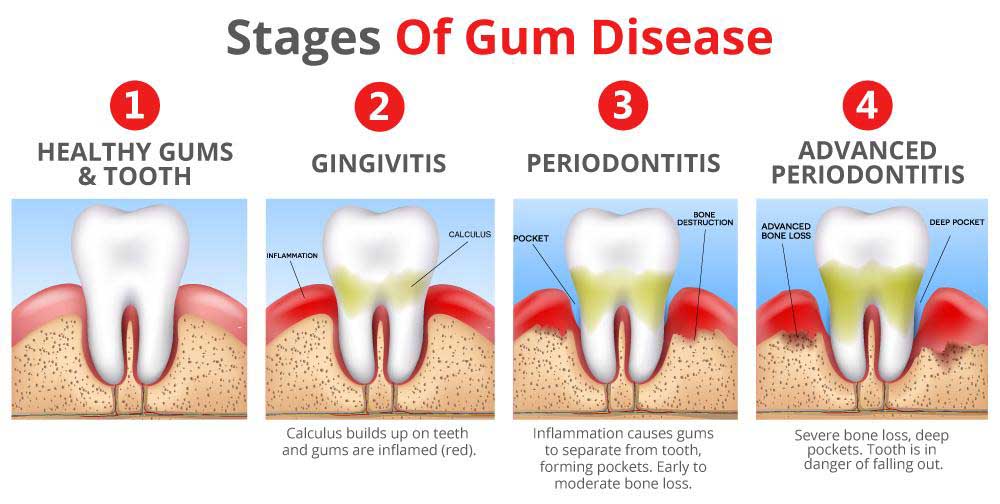 Stages of Gum Disease - Scale And Polish To Avoid