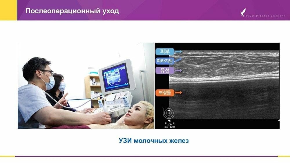 Кейс по маммопластике (увеличению груди) в Корее Mammoplastika 20191016 V2 5 - Кейс по маммопластике (увеличению груди) в Корее