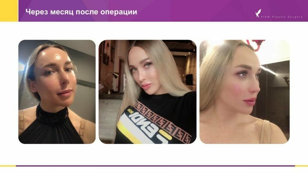 Кейс по контурной v-line коррекции и ринопластике в Корее Konturnaya plastika Inna 20191112 V2 13 1024x576 - Кейс по контурной v-line коррекции и ринопластике в Корее