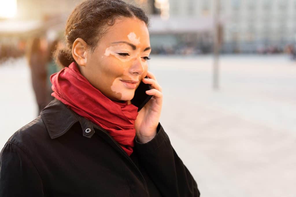 A beautiful young girl of African ethnicity with vitiligo standing on the warm spring city street using mobile phone close up portrait of woman with skin problems.