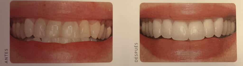 coronas dientes mal alineados