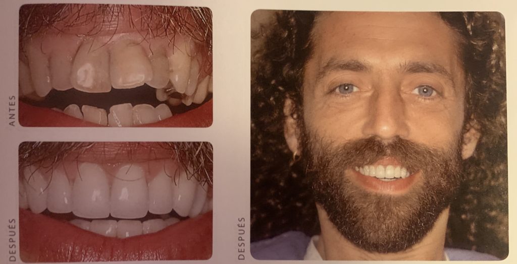 coronas dientes torcidos