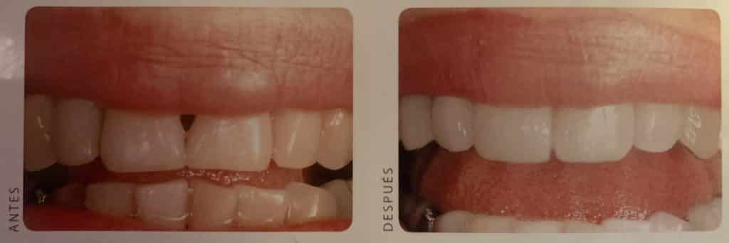 enfermedad periodontal