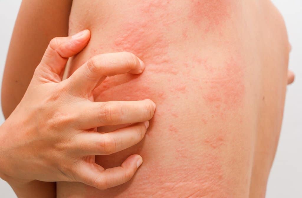 Seboroični dermatitis