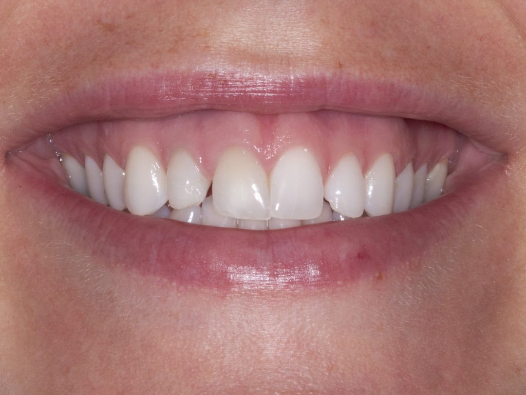 Raising the gum line for a gummy smile Raising the gum line