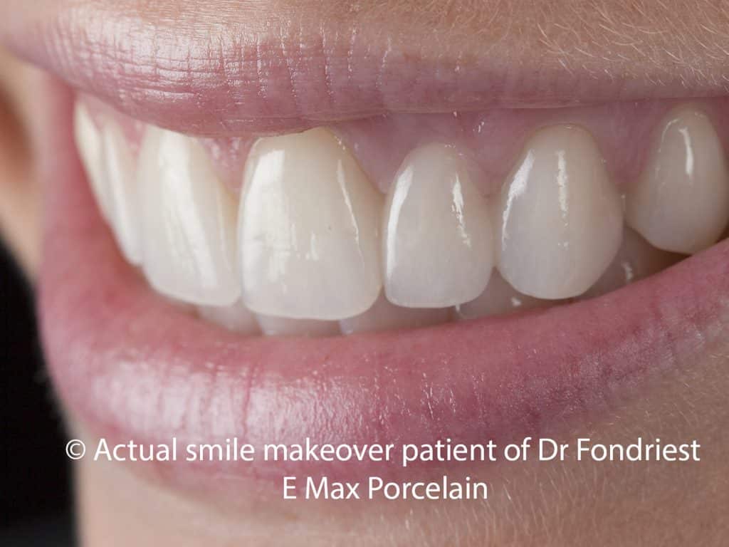 A "dental bridge" to replace a missing tooth Dental bridge