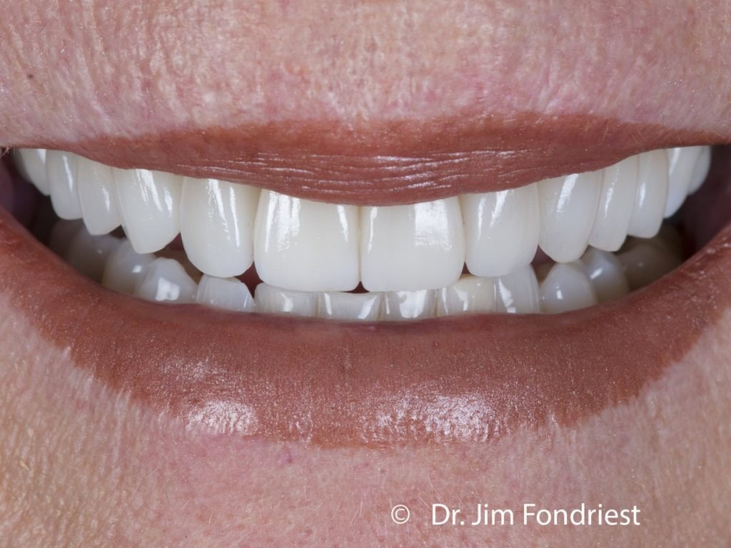 Veneers Without Drilling No Drill Veneers Save Enamel