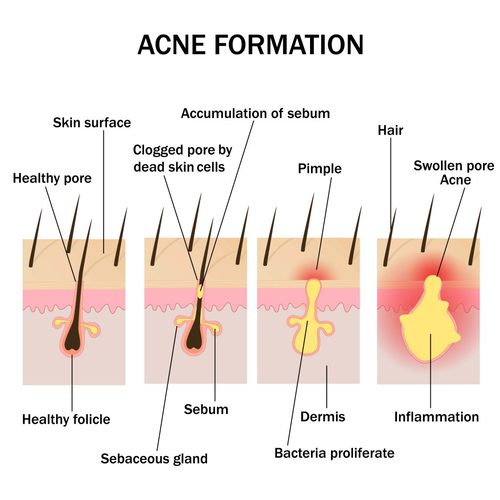 Skin consists of follicles, whcih may get blocked due to sebum, dead skin cells. USe these home treatments for acne to clear up debris and get clear skin
