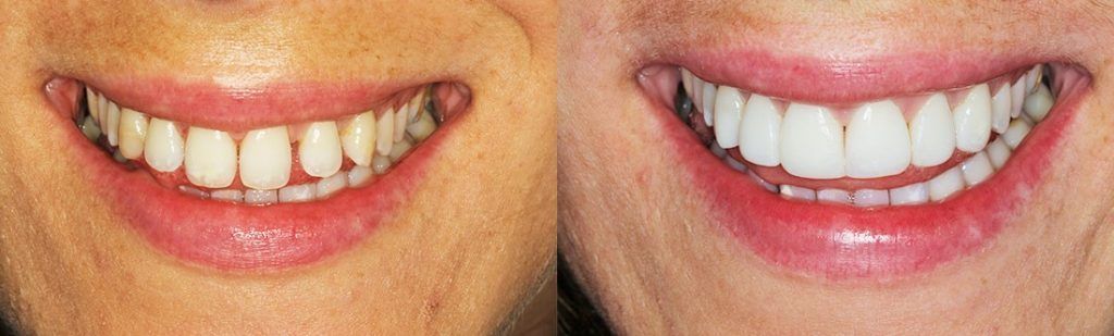 Composite Bonding Composite Bonding at Gurgaon