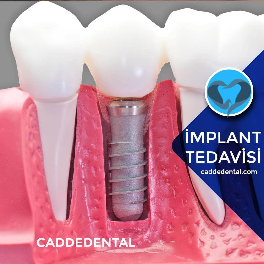 implant tedavisi