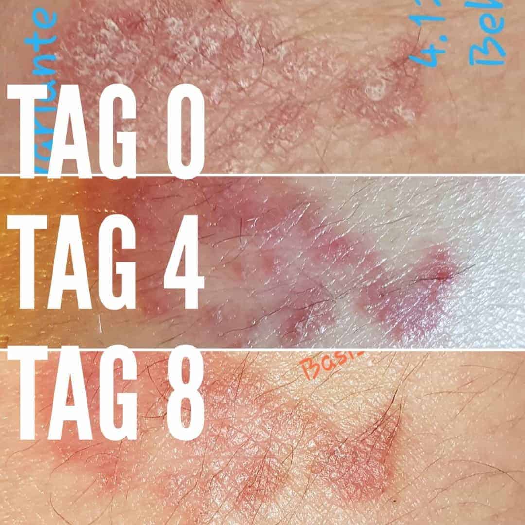 malantis-cbd-skinbalm-haut-01 CBD gegen Schuppenflechte
