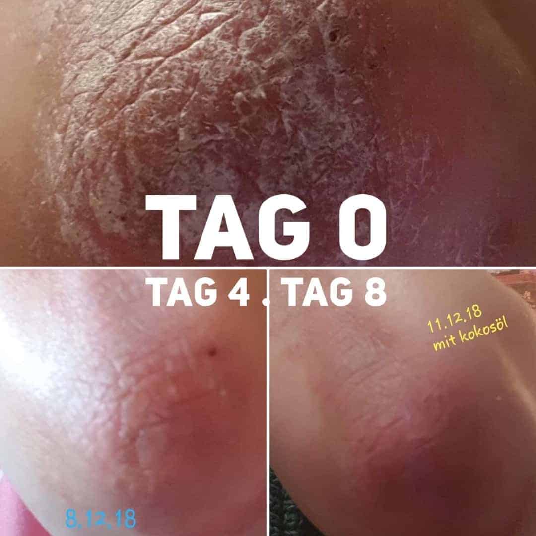 malantis-cbd-skinbalm-haut-02 CBD gegen Schuppenflechte
