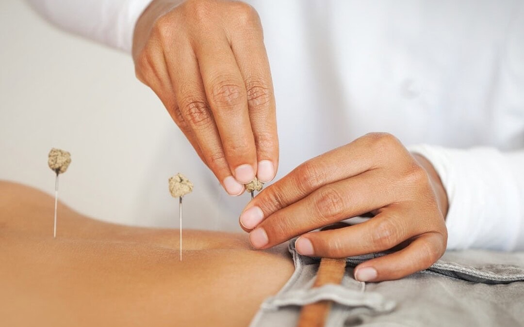 West Palm Beach Acupuncturist