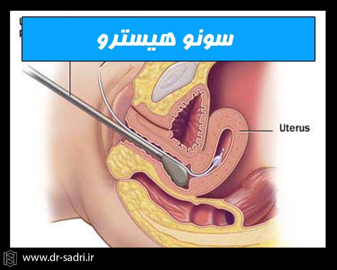 نحوه انجام سونوهیسترو