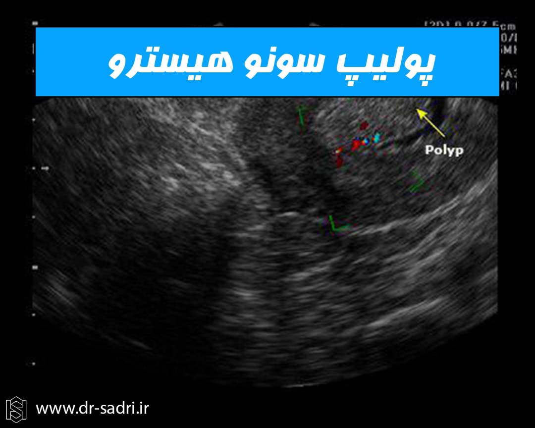 پلیپ سونوهیسترو
