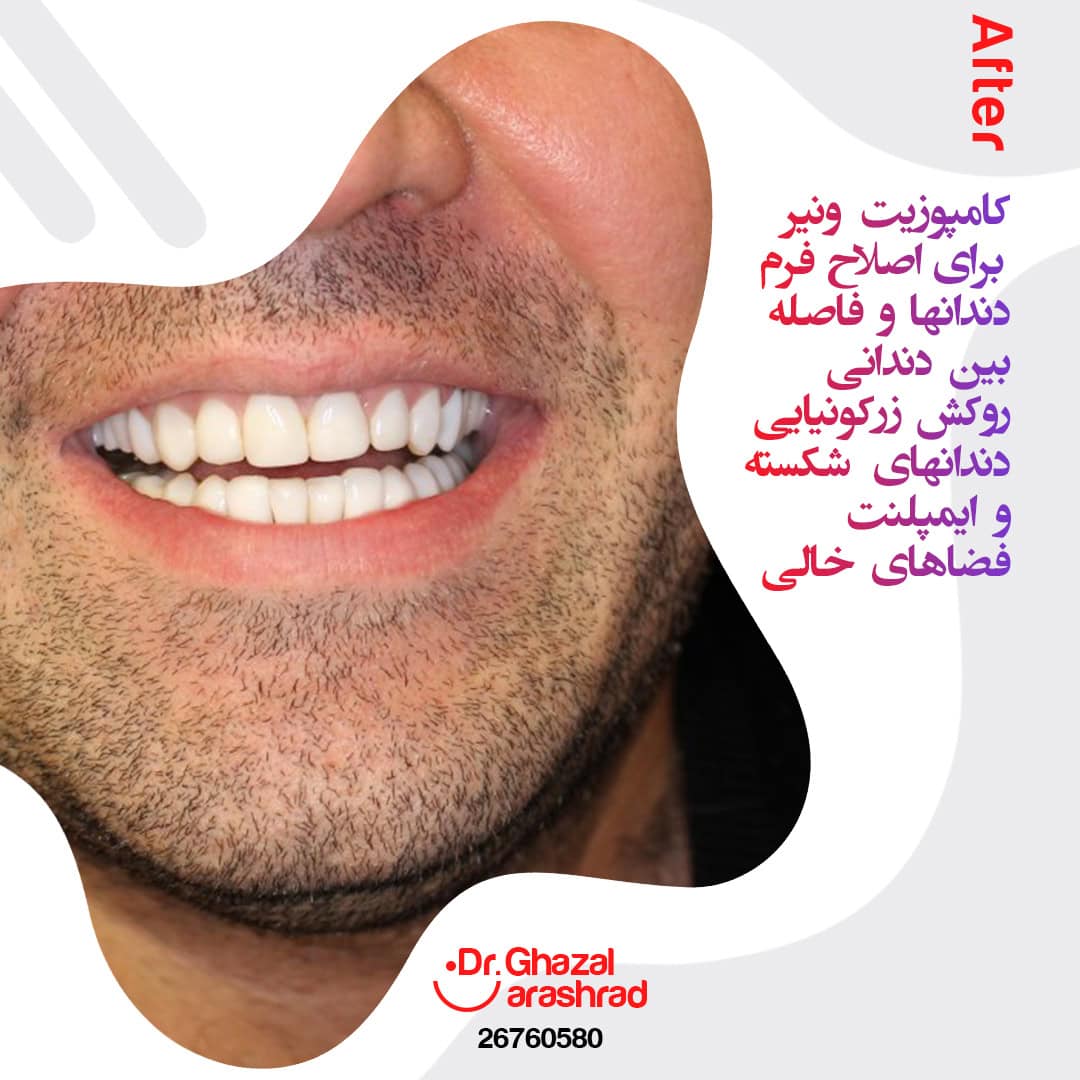 معایب کامپوزیت ونیر