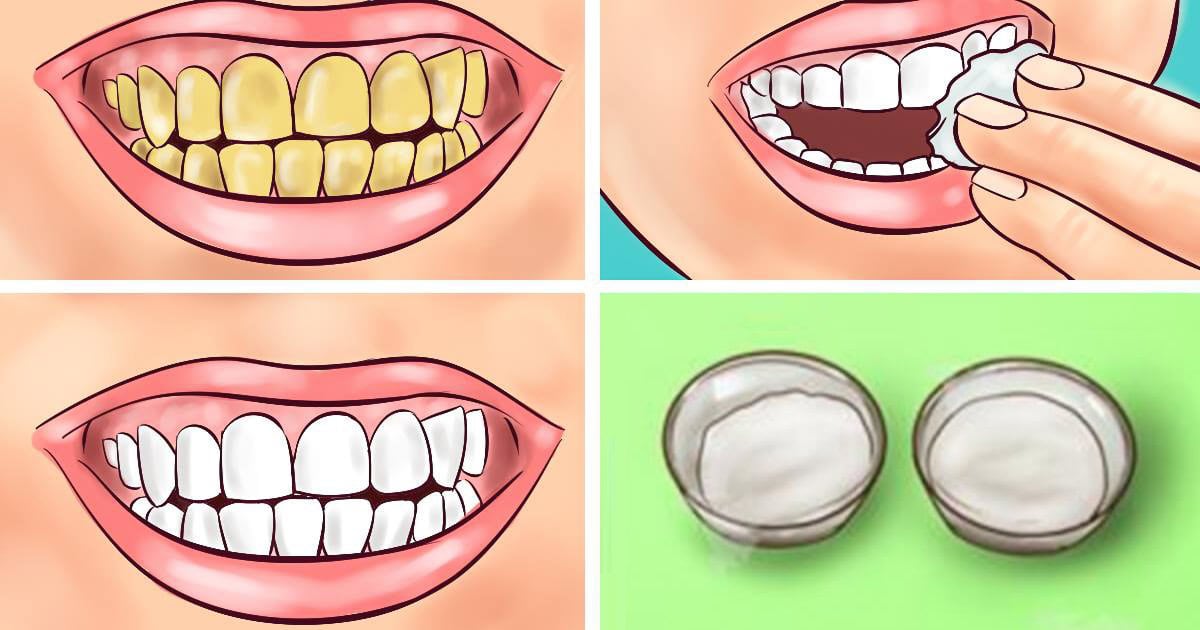 Guaranteed! Whiten Your Yellow Teeth In Less Than 2 Minutes!