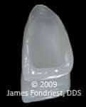 porcelain contact lens effect The porcelain can be made thin enough to have a contact lens effect