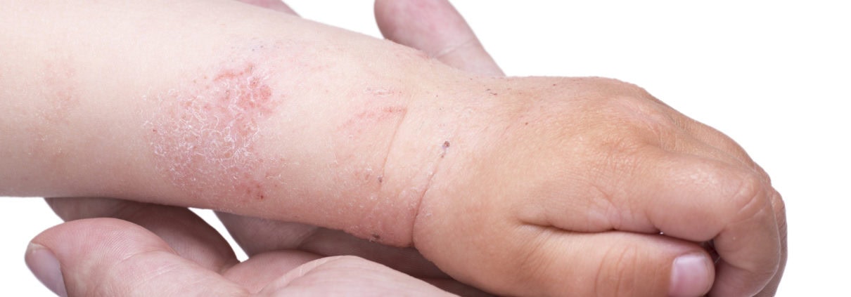 Prevent Eczema Flare Ups In Winter Natural Allergy Treatment