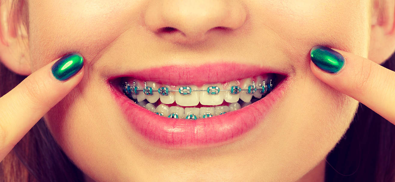 Types of Braces