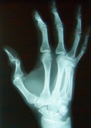 Lacrosse goalie thumb protector clearance