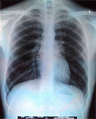 "Chest X-ray" by Aidan Jones "Chest X-ray" by Aidan Jones