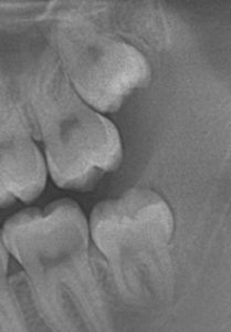 Section of OPG X-Ray Showing position of Wisdom Teeth