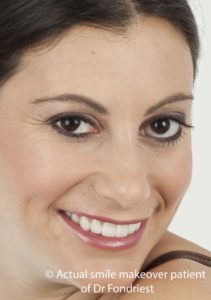 Smile improvement with crowns Prosthodontic Smile Improvement