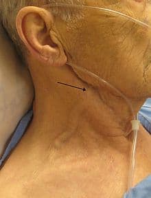 Increased jugular pressure is a common feature of heart failure
