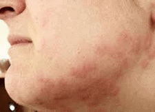 bed bug bite pictures