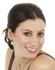 Smile enhancement by Chicago cosmetic dentist Beautiful cosmetic dentistry