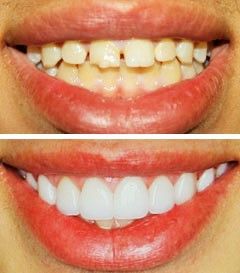 Dental Veneers Best Dental Veneers India