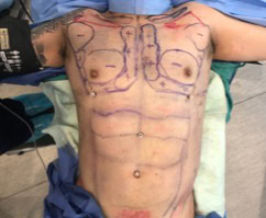 Male High Definition Liposuction Preoperative Markings