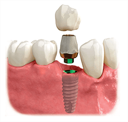 Dental Implants Melbourne