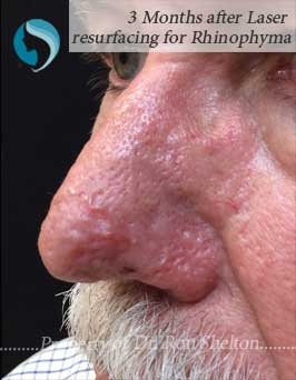 rhinophyma-after-6 3 Months after Laser Resurfacing for Rhinophyma