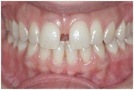 Before Diastema Treatment (Orthodontic) Gap in Teeth Treatment