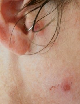 Impetigo or school sores school sores lesions ( impetigo) in adult , caught from child. caused by staphylococcus horrible tropical disease
