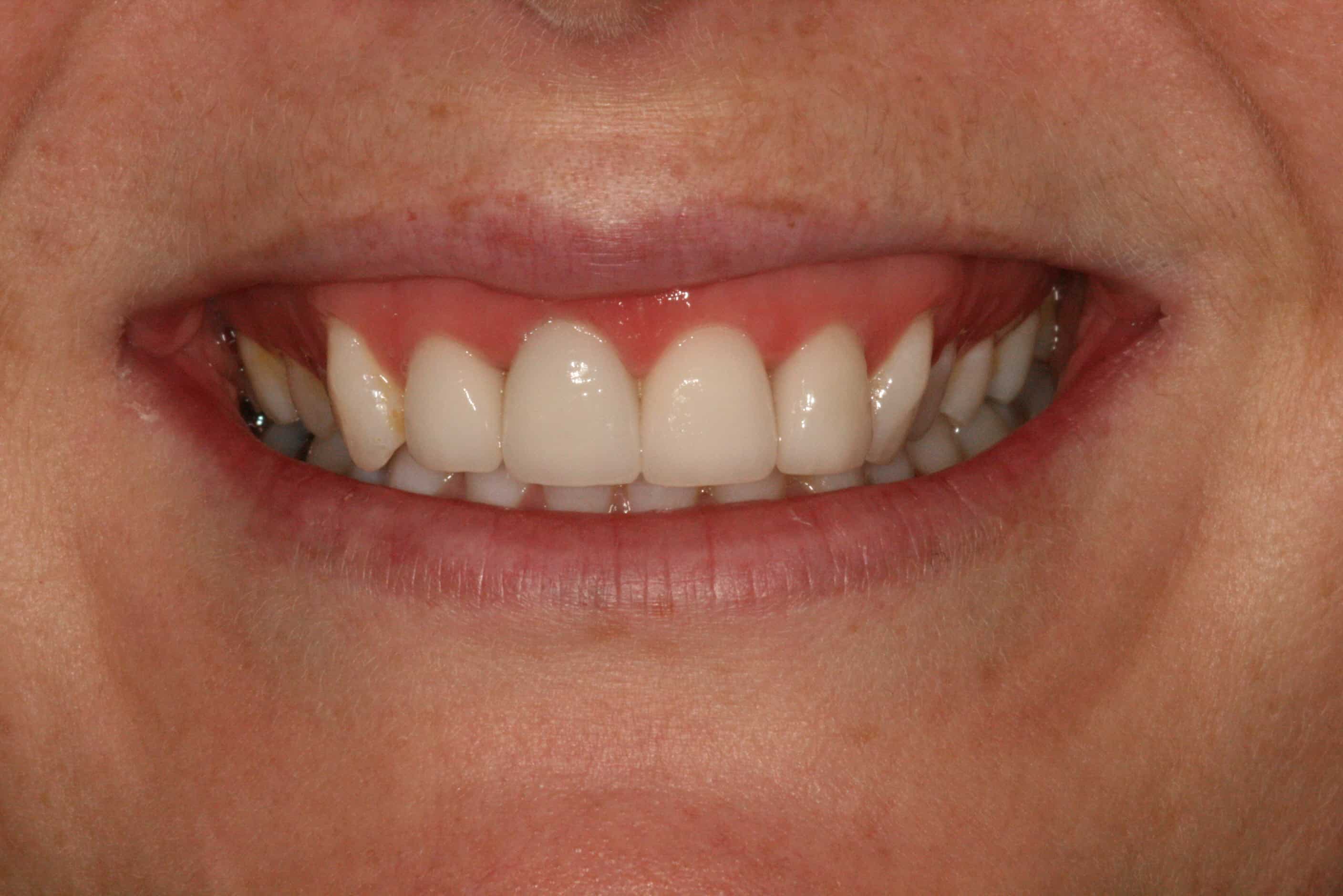 dental crowns dental crowns