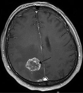 Brain Tumors