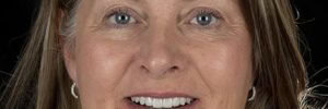 Are teeth implants worth it?