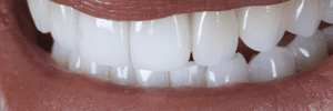 Designing your smile