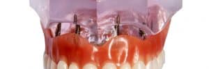 Retain Your Dentures with implants