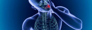 When TMD (or temporomandibular joint disorder) strikes, it can have several wide-ranging consequences. Depending on the exact nature and extent of your condition, those may include sore and painful facial muscles, a popping/clicking jaw, and in some cases, increasingly more sensitive teeth. Though the dysfunction centers on your jaw’s joints (TMJs), one of the many symptoms it can generate is the unconscious habit of grinding your teeth. When left untreated, TMJ disorder and resulting teeth-grinding can cause your teeth to hurt as well as the components of your jaw. How TMJ Disorder Affects You TMJ disorder can describe a number of different conditions that disrupt the proper function of your temporomandibular joints. For instance, one or both of your jaws may be damaged, out of proper alignment, chronically inflamed, and/or experiencing arthritis. Or, you may have suffered an injury to one or both joints, making it more difficult for them move as needed. For many patients, the discomfort can cause jaw joints and muscles to spasm, forcing your teeth to grind together. What It Does to Your Teeth Known as bruxism, the chronic grinding of your teeth can lead to several more compounding complications. Over time, the friction wears down the protective enamel of your teeth, which makes them more sensitive to irritations like food particles, beverages, and oral bacteria. If left untreated, it can also cause cracks, fractures, and breaks to occur in one or more teeth. Fortunately, your dentist may be able to help you address both your TMJ disorder and your sensitive teeth with a custom-designed oral appliance and appropriate restorative treatment, if necessary. What Causes TMJ Disorder? There are many different reasons why TMJ disorder can occur. This condition is likely connected to the actual jaw joints or the associated muscles in the area. TMJ disorder may be caused by: • Blunt force trauma: If you are involved in a fall, vehicular accident, or sports-related injury, it can damage your jaw and affect its alignment. As a result, the muscles work to overcompensate. • Bruxism: As mentioned above, bruxism is a condition in which individuals clench or grind their teeth together. This can occur during the day or night, but most often occurs during sleep. This is one of the leading causes of TMJ issues. • Erosion of the articular disc: If the jaw joints are not seated properly, the cushioning discs can erode or wear thin over time. When these changes occur, it can affect your bite and your TMJ. • Arthritis: This condition can erode or wear down cartilage in the jaw joints. • Stress: When you are anxious or stressed, you are at a higher risk for grinding your teeth. As a result, many individuals experience heightened TMJ issues during times of great stress. How Can I Prevent Tooth Sensitivity Caused by TMJ Disorder? If you are experiencing tooth sensitivity, there are many different factors to consider when determining appropriate treatment. However, if your condition is occurring due to TMJ problems, then there are a few things you can do to address the situation. In the sections below, we will explore both professional and at-home treatments for TMD-induced tooth sensitivity. Professional Treatments for Tooth Sensitivity The first line of defense against tooth sensitivity caused by TMD is a custom oral appliance. This device fits comfortably and snugly over your teeth to reduce the effects of grinding or clenching. In fact, your oral appliance can be custom-made to place your lower jaw in a more favorable position, thereby alleviating pressure in the jaw joints. Dental crowns can also protect teeth that are vulnerable to sensitivity. A crown covers the entire visible portion of a tooth, offering defense against extremely hot, cold, or sugary foods. Keep in mind, however, if the initial cause of your tooth sensitivity is TMD, you will likely need to wear an oral appliance to protect your new investment (and your oral health). To combat dental sensitivity, your hygienist or dentist can place topical fluoride. This substance can be applied in gel, foam, or liquid form, and can be performed at every routine dental cleaning. In extreme situations, your doctor may even recommend a muscle relaxant to help alleviate jaw discomfort. In turn, this should reduce the likelihood of tooth sensitivity. Home Remedies for Tooth Sensitivity First and foremost, if you are experiencing tooth sensitivity, use a desensitizing toothpaste. This offers a daily defense against discomfort to heat and cold. Generally, it takes a few days of use to notice a difference. However, if used consistently, it can deliver impressive results. Other home remedies include: • Cold compresses: If one or more of your teeth feel tender or sore, apply an ice pack or cold compress to the external jaw. This can reduce any inflammation in the jaw muscles and help alleviate your discomfort. • Salt water rinses: Add a half a teaspoon of salt to a glass of warm water. Rinse with this solution a couple of times a day to keep harmful bacteria at bay and help reduce sensitivity. • Green tea: Packed with anti-inflammatory and antioxidant properties, green tea can be used as a desensitizing mouthwash. Simply swish with unsweetened green tea for about 30 seconds twice a day. Symptoms of TMJ Disorder There are several warning signs that indicate the presence of TMJ disorder. Many patients experience: • Pain in the jaw joints • Toothaches • Tooth sensitivity • Radiating pain from the jaw to the ear or temples • Headaches • Earaches • Tinnitus, or ringing in the ears • Discomfort or difficulty while chewing • Lockjaw • Orofacial pain If you are experiencing any of these symptoms, it is important to see a dentist right away. With early intervention, you can alleviate your discomfort and prevent further damage from occurring. Contact Lake Forest Dental Arts Today If you suffer from TMJ disorder, then some symptoms (like bruxism) can lead to sensitive teeth as well as its many other symptoms. To learn more, schedule a consultation by calling Lake Forest Dental Arts in Lake Forest, IL, at 847-234-0517. We also proudly serve residents of Lake Bluff, Chicago, Libertyville, Gurnee, Highland Park, Vernon hills, Winnetka, Wilmette, Kenilworth, Bannockburn, Ravinia, and all surrounding communities in the Chicago Metro area.