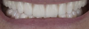 Full mouth reconstruction