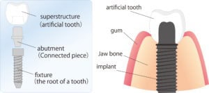 patient with Hypodontia