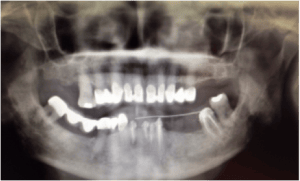 Implants dentaires mandibulaires dentiste amouyal paris 16