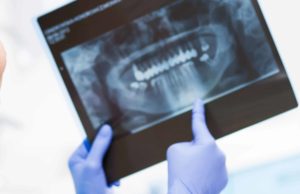 Tooth cavity