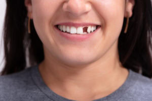 restore your smile incomplete smile