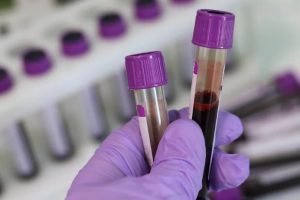 HIV Blood Test